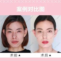 明星面部埋线